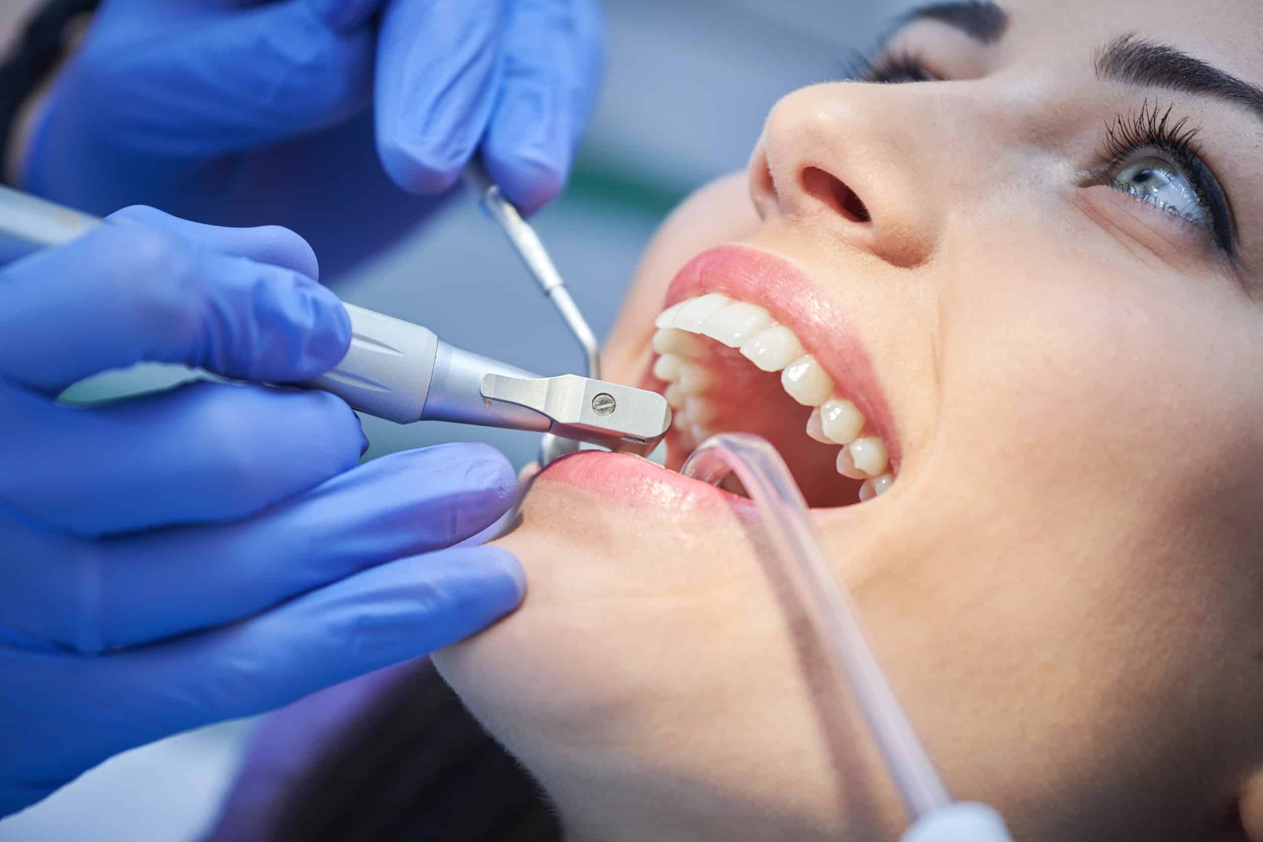 The Dentist teeth cleaning made simple