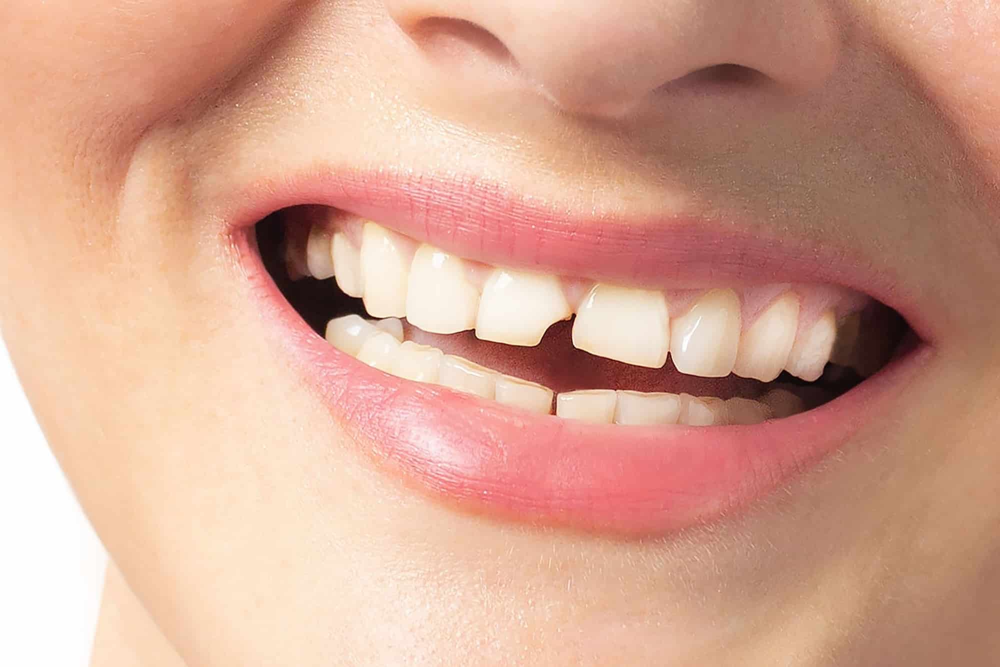 does a chipped tooth grow back