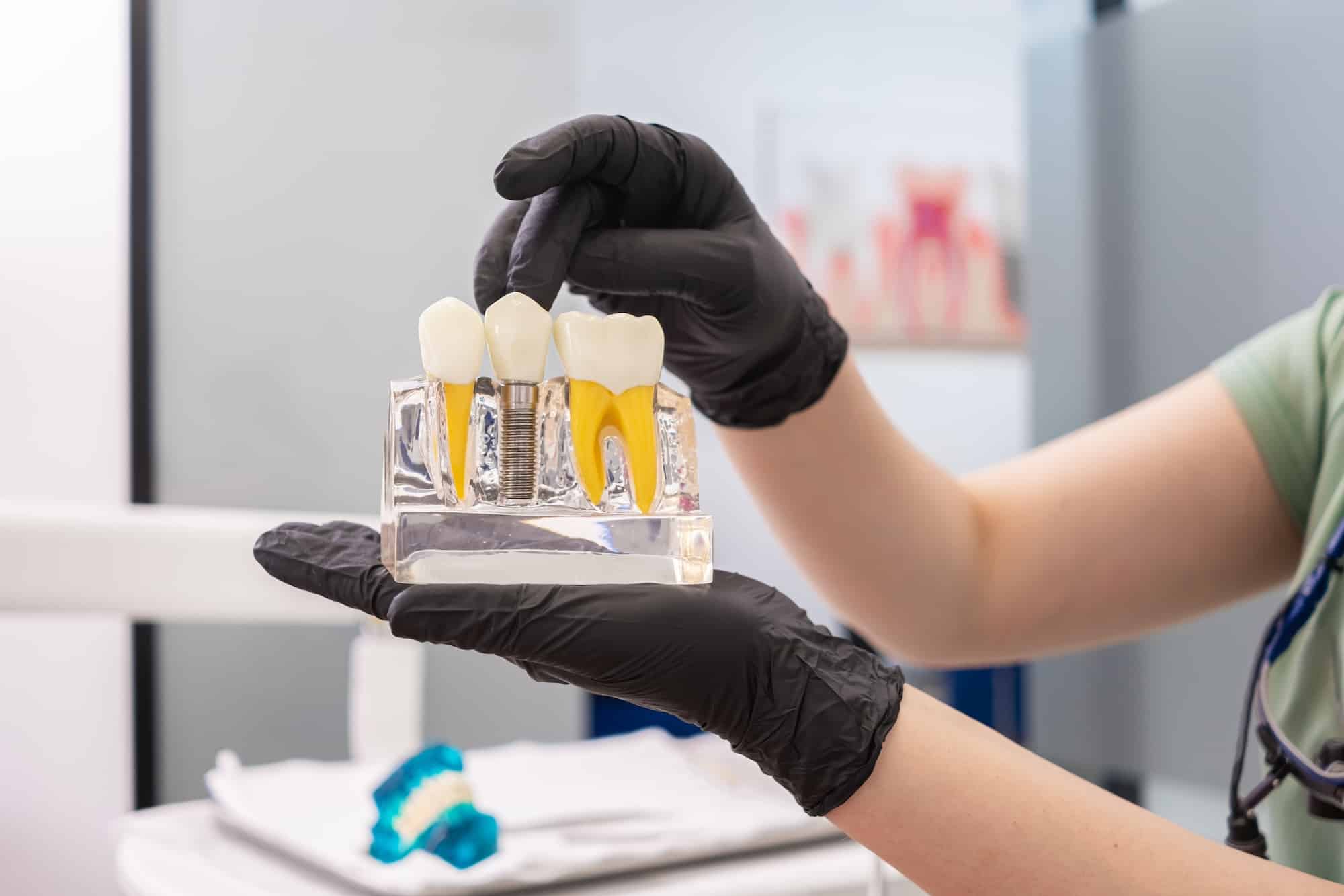 dental expert holding dental implant teeth model