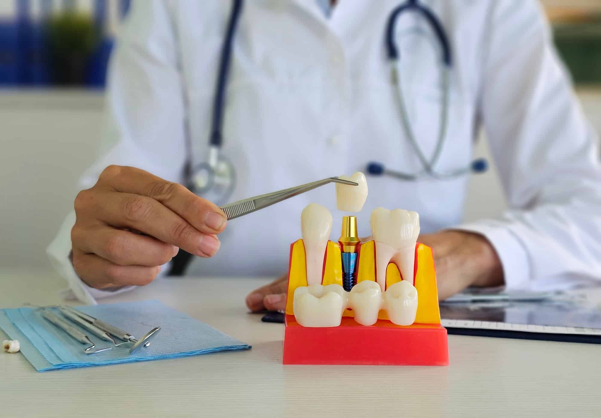 how dental implants are done