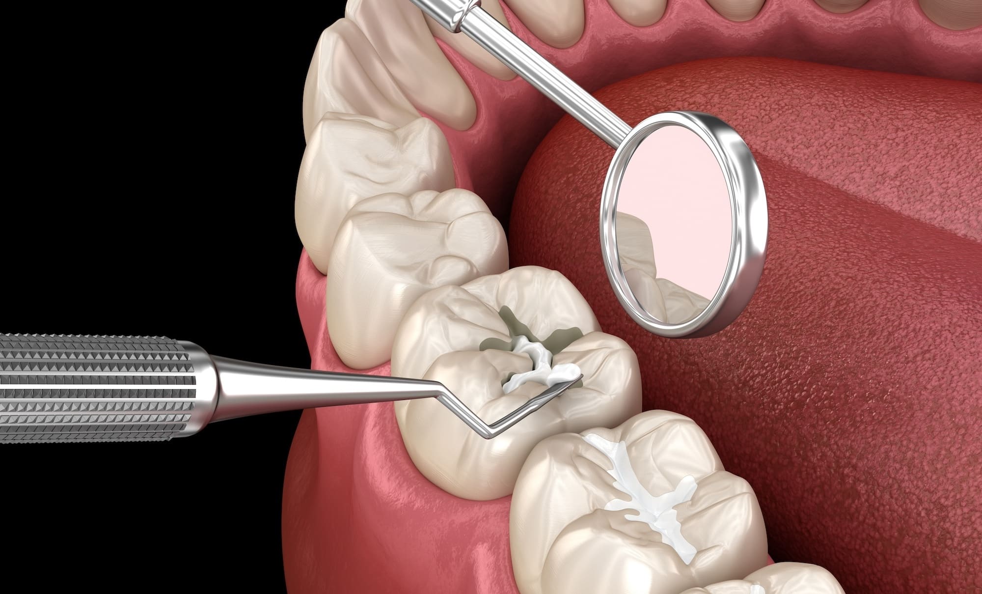 are dental fillings painful