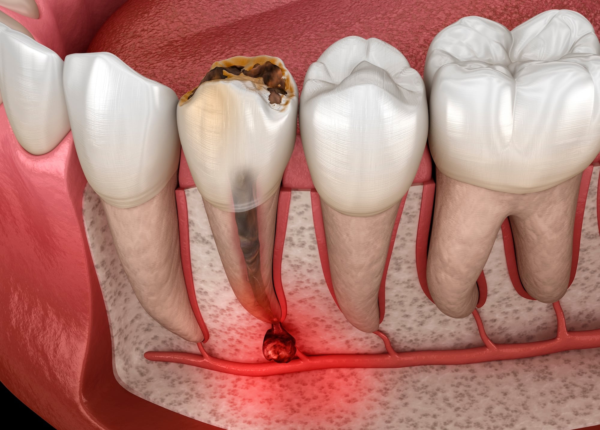 root canal infection 3d illustration