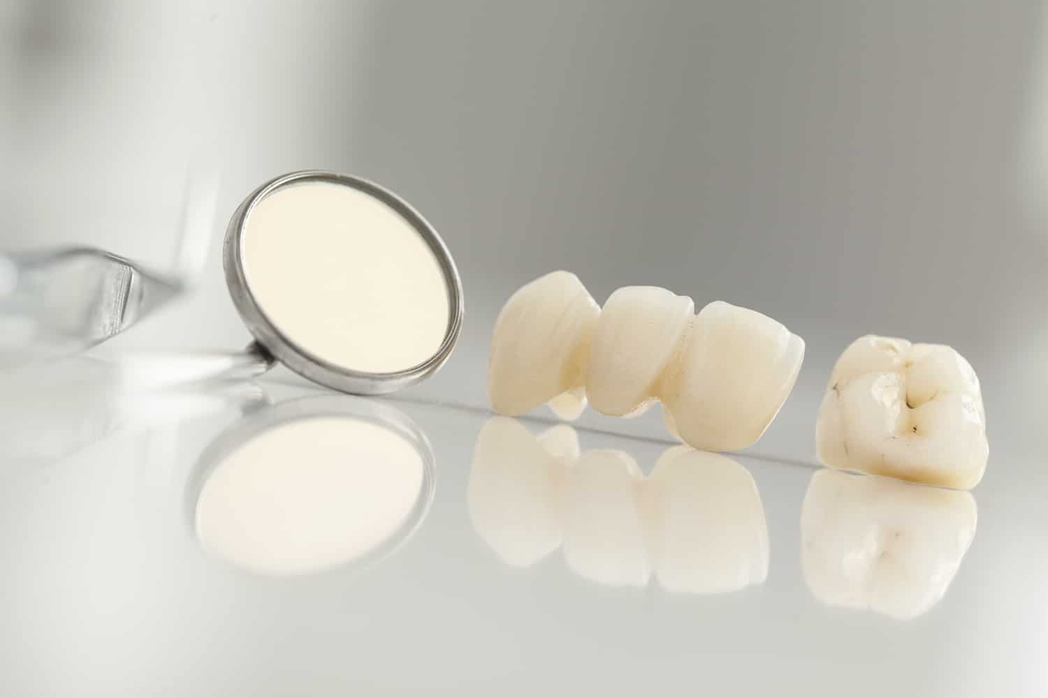 single tooth bridge up close