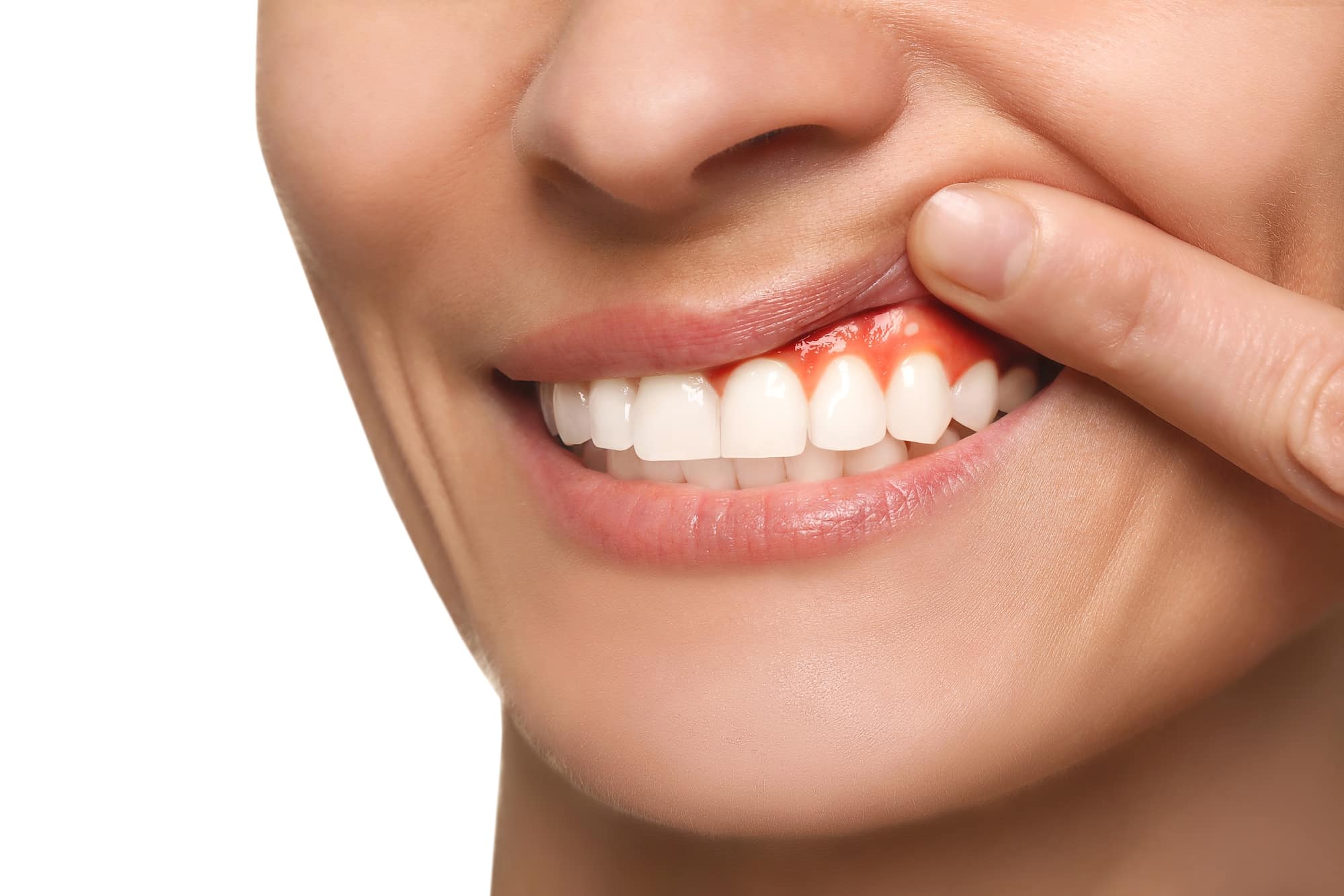 inflamed gums after flossing