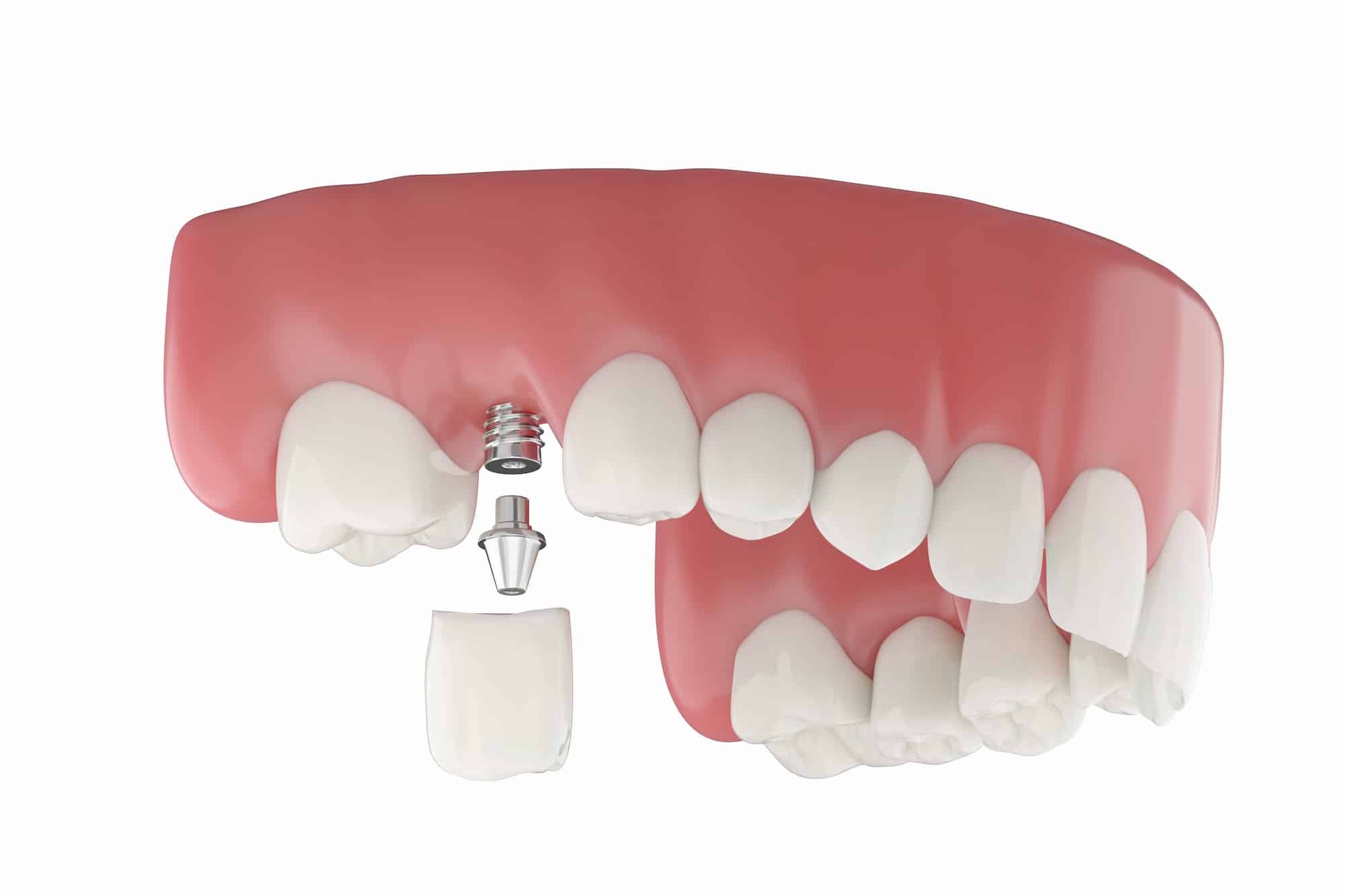 molar dental implants