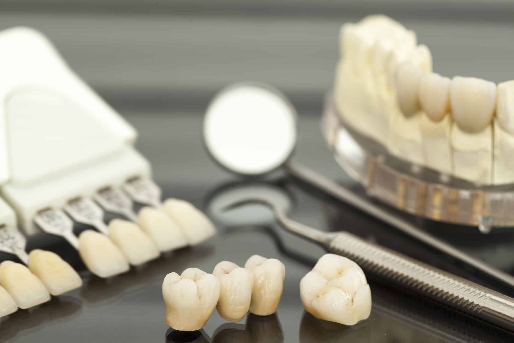 professional dental bridges