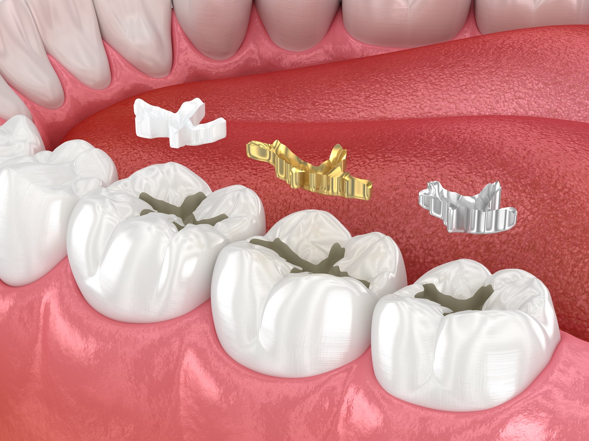 Can cavity fillings fall out