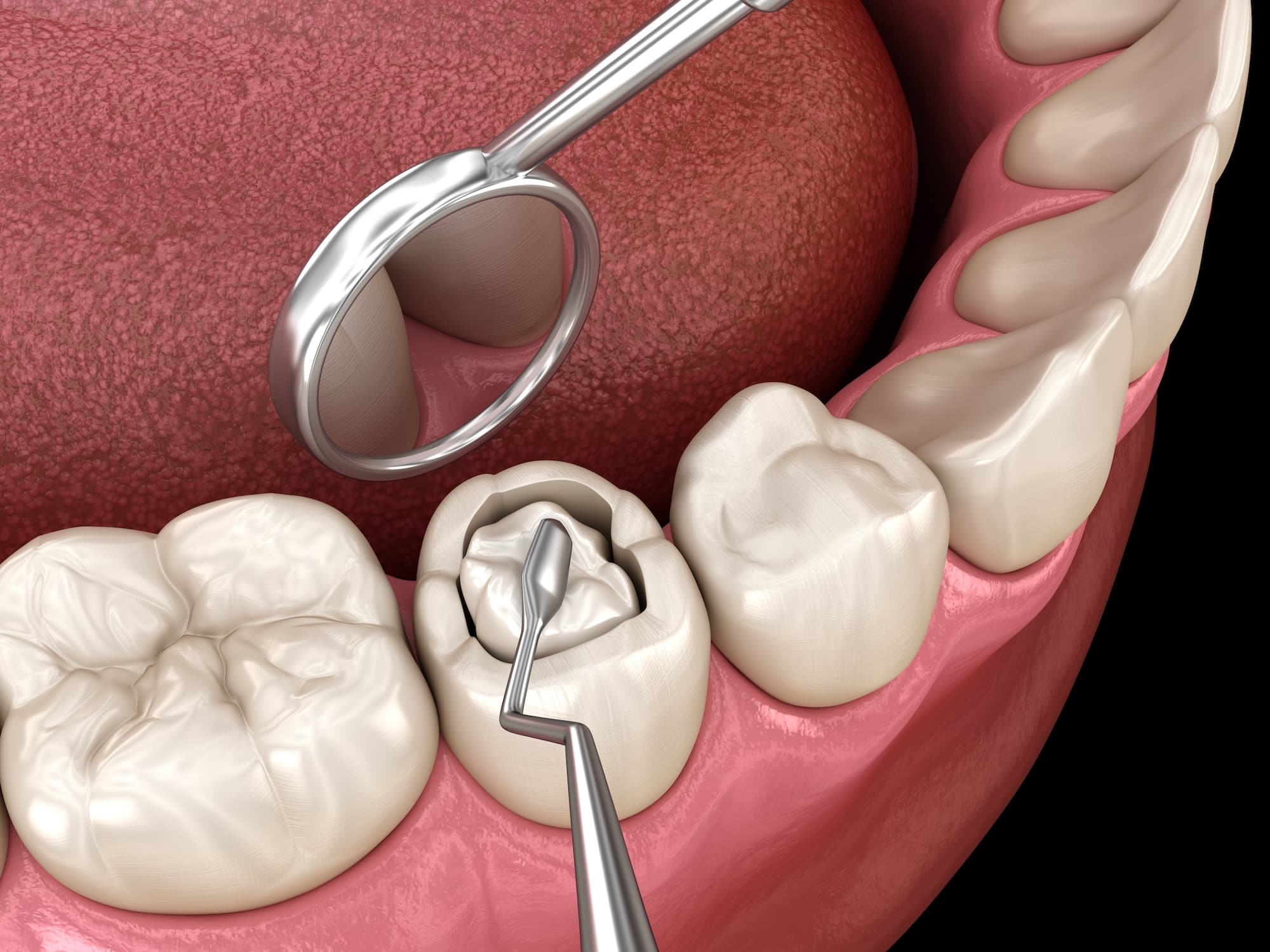 composite dental filling root filling