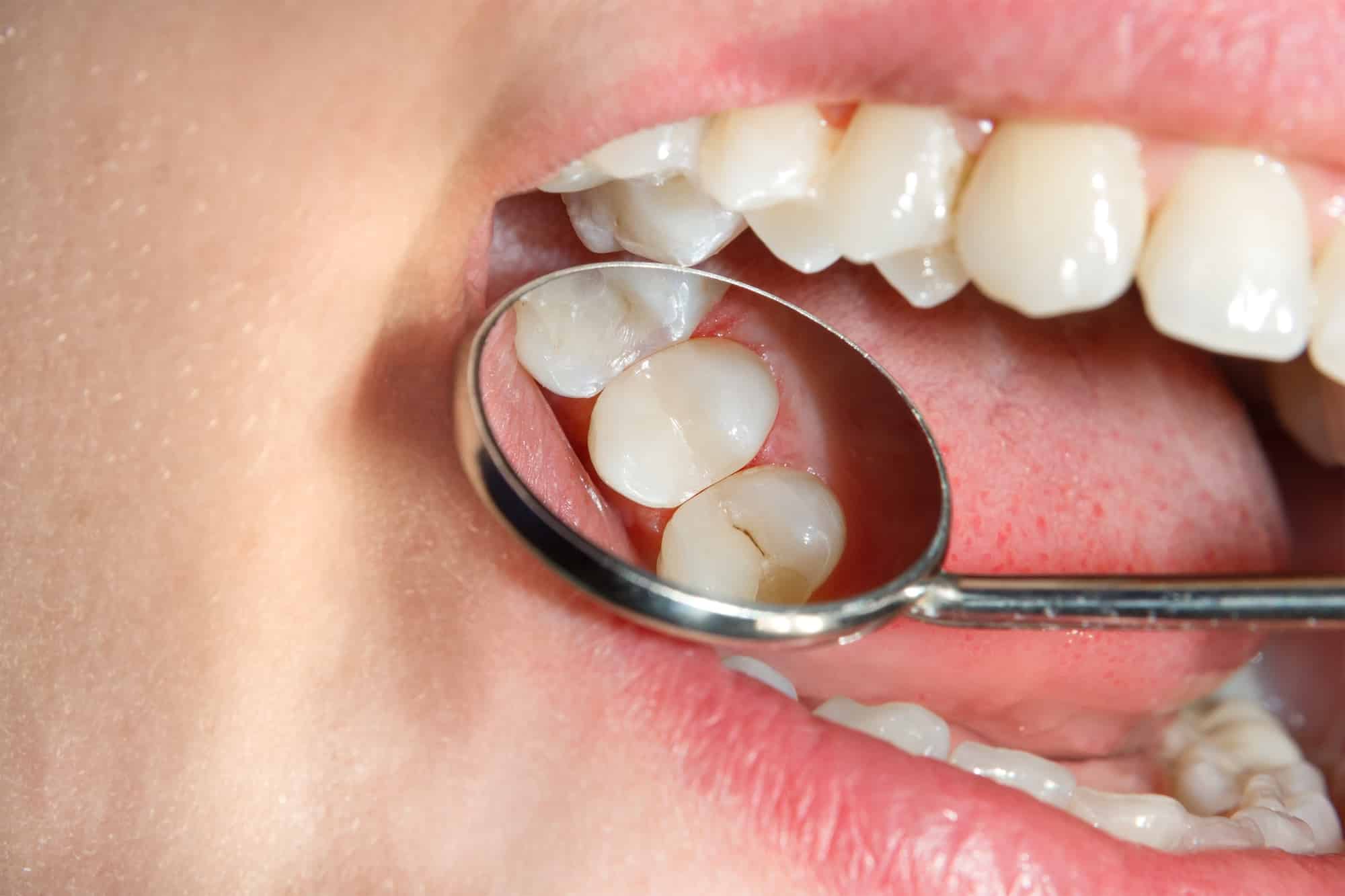 how long do cavities take to form