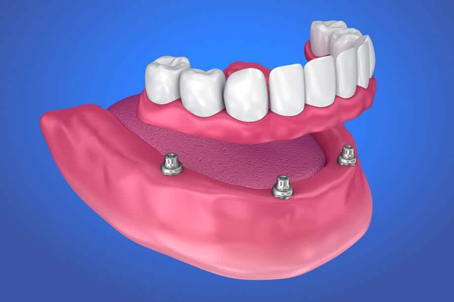Full denture restoration