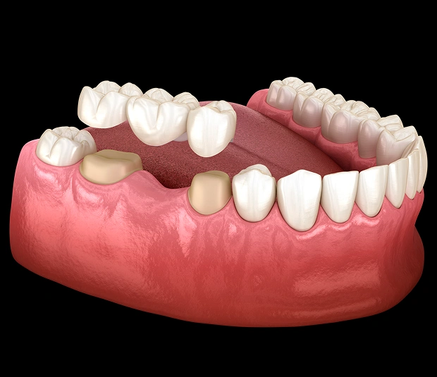 Replace Missing Teeth With a Stable, Natural-looking Solution
