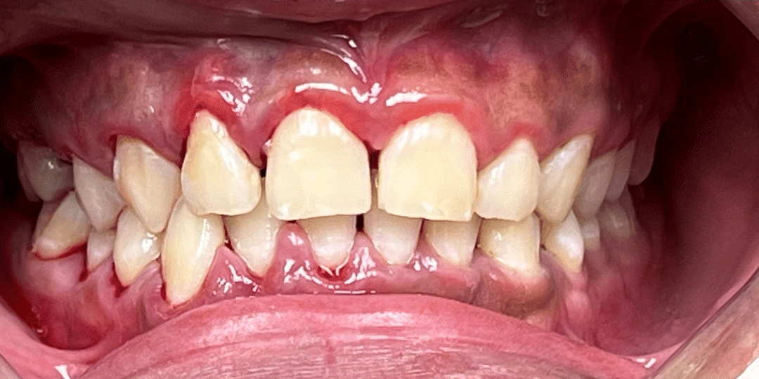 Dental cleaning After