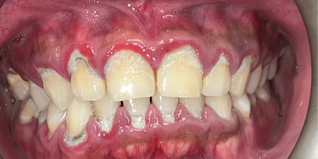 Dental cleaning Before