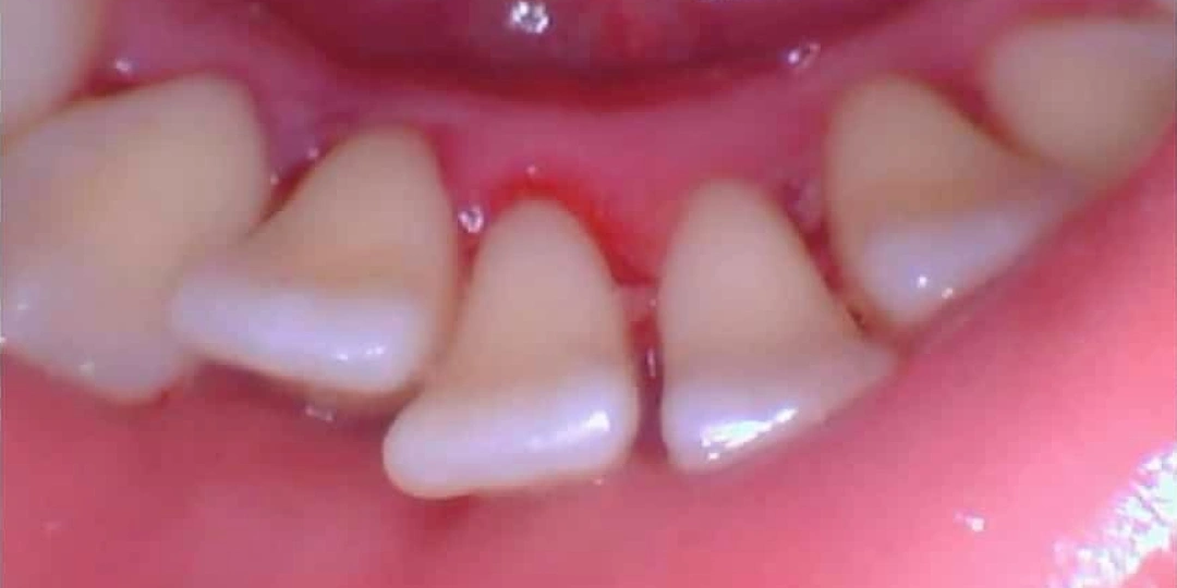 Dental Cleaning Treatment After