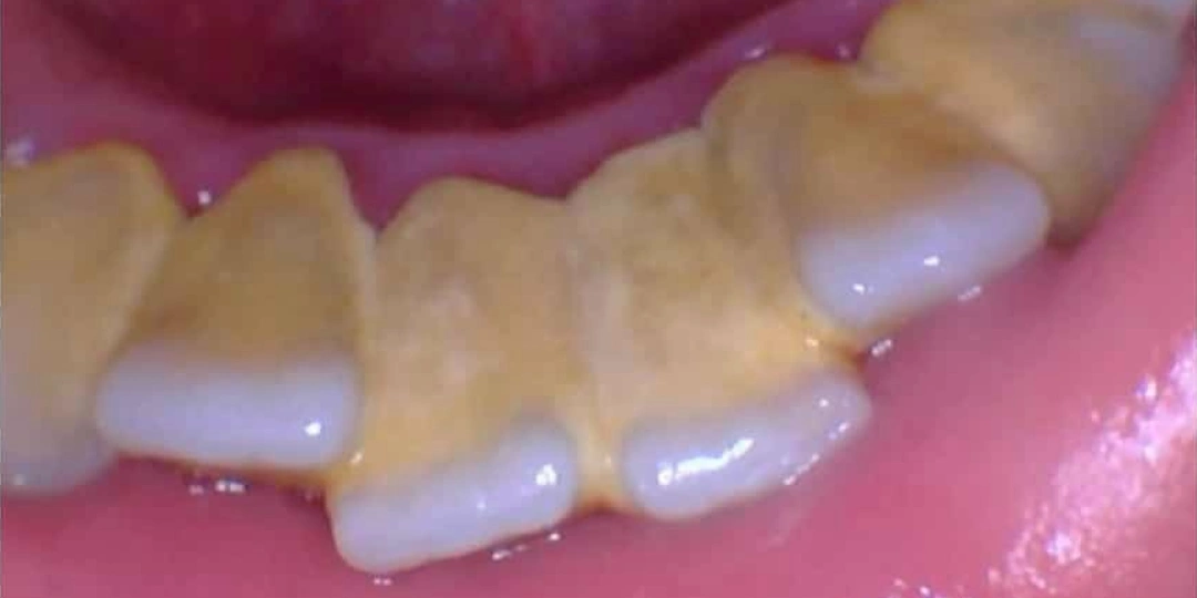 Dental Cleaning Treatment Before