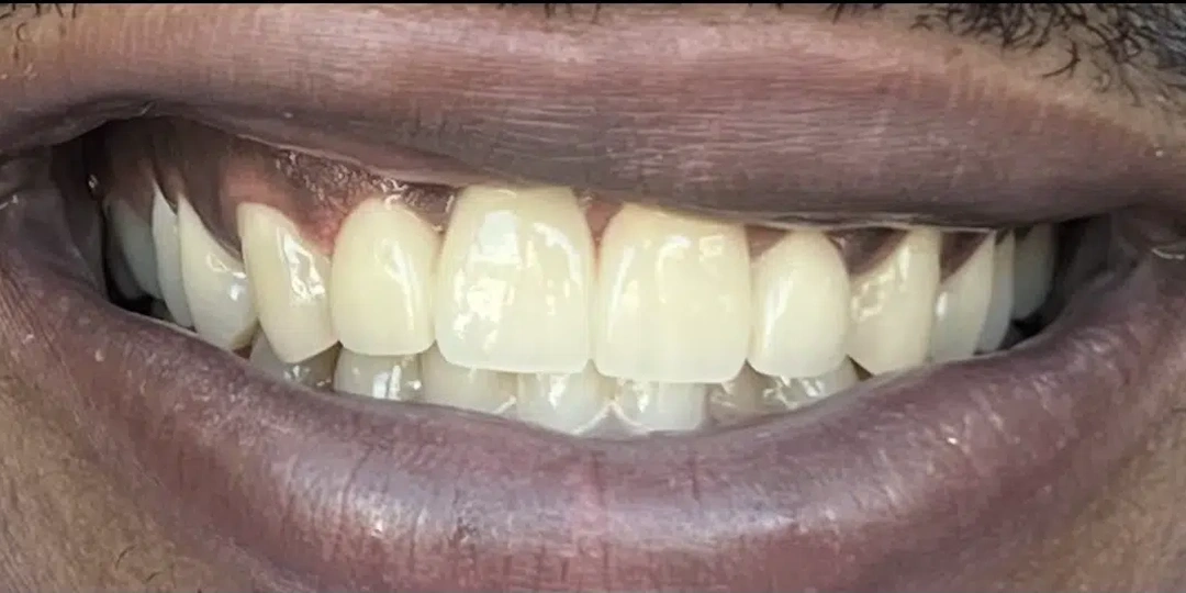 Dental Implants After