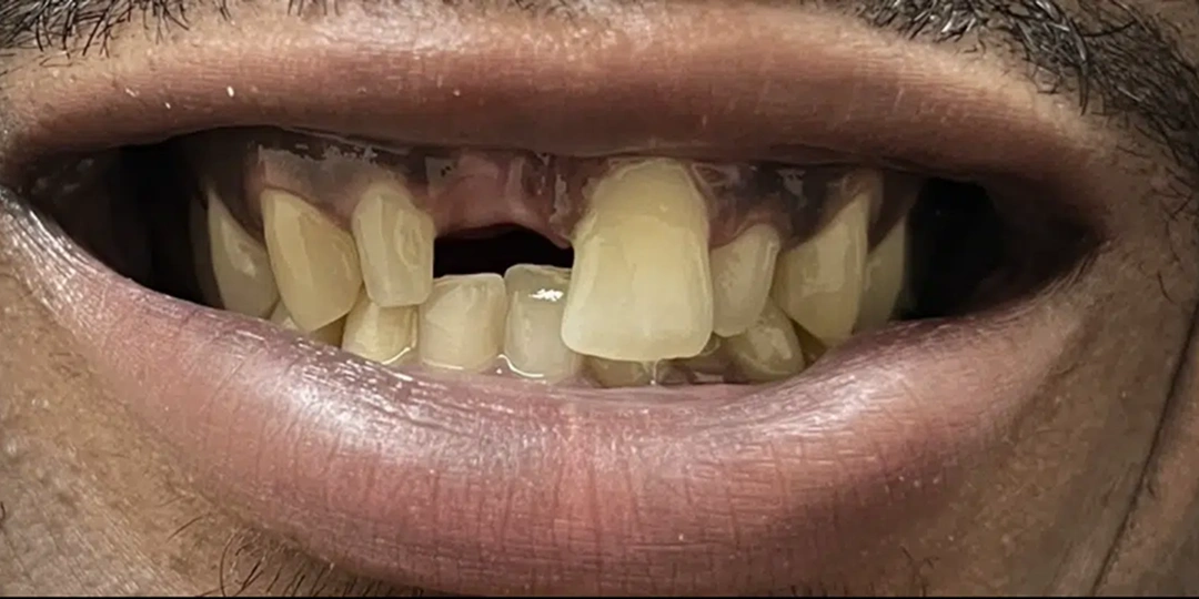 Dental Implants before