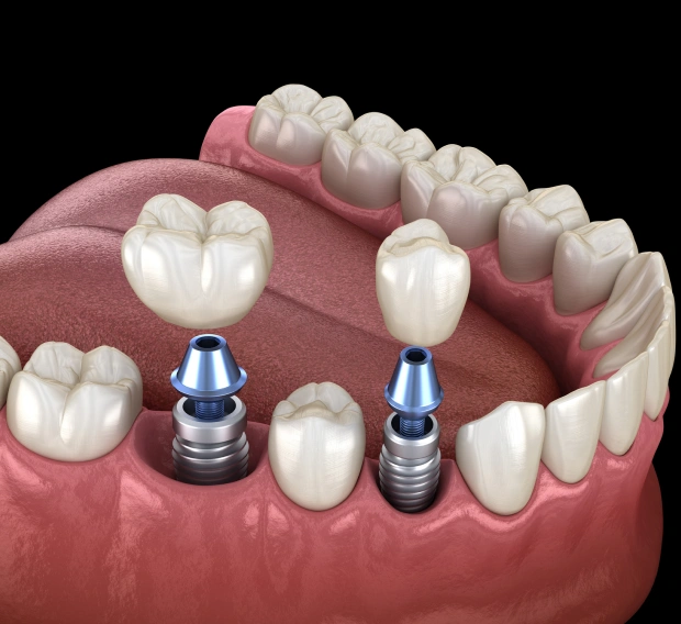 Dental implants for permanent tooth replacement and smile restoration