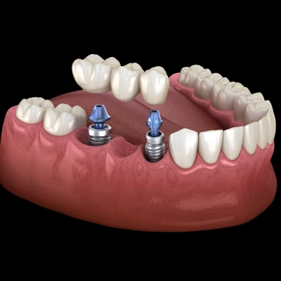Implant-supported bridge restoring multiple missing teeth