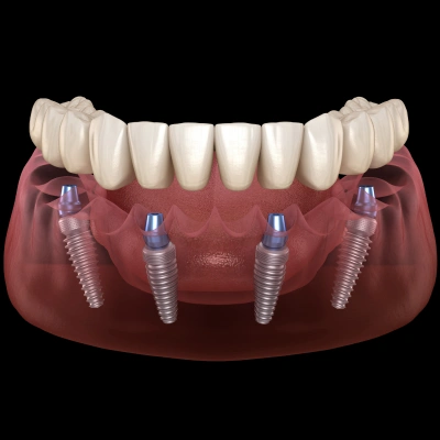 Implant-supported dentures providing a secure smile restoration