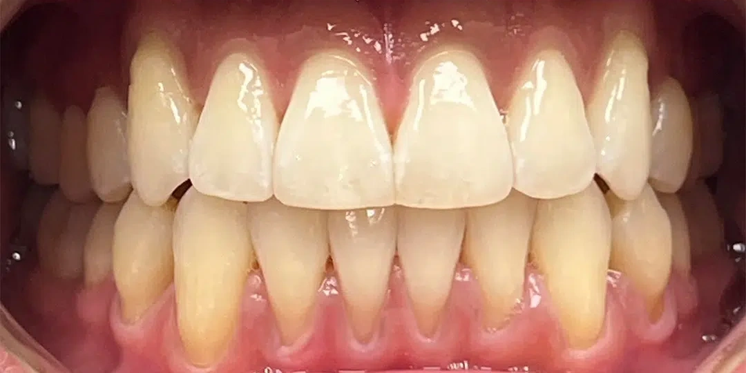 After clear aligner treatment showing a straighter smile