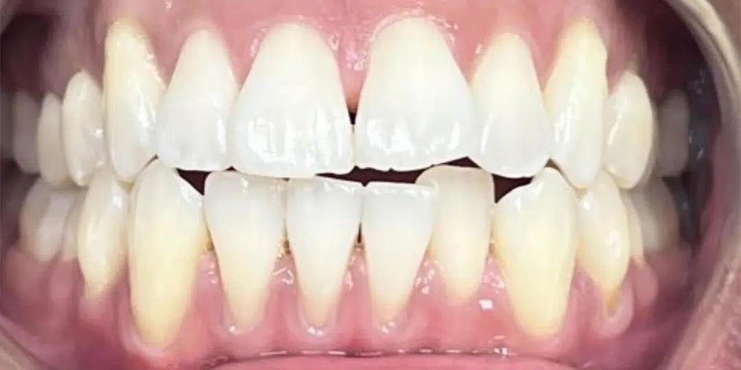 Before clear aligner treatment showing misaligned teeth