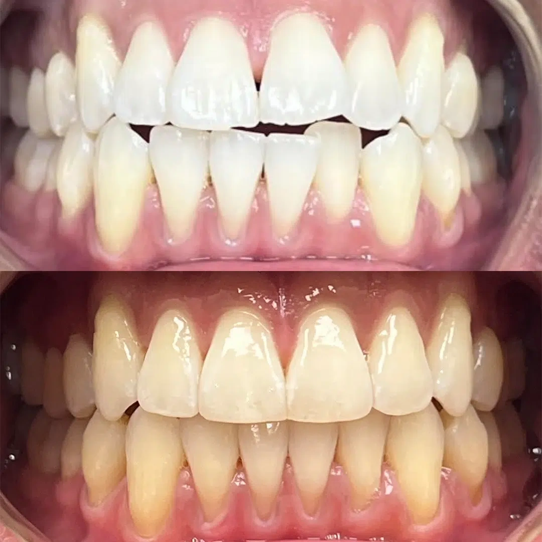Invisalign Clear Aligner before/after