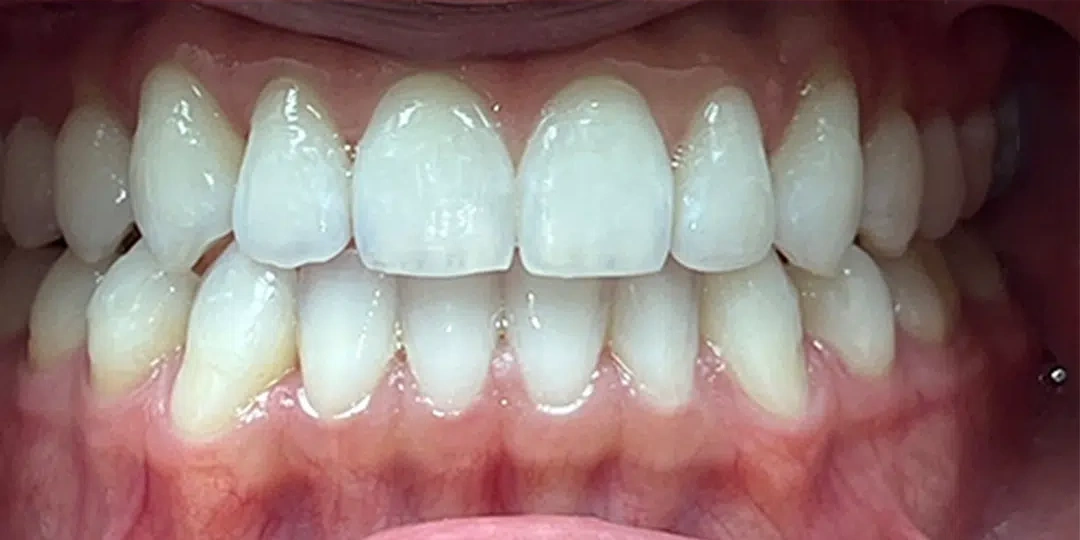 After Invisalign treatment correcting crowded teeth