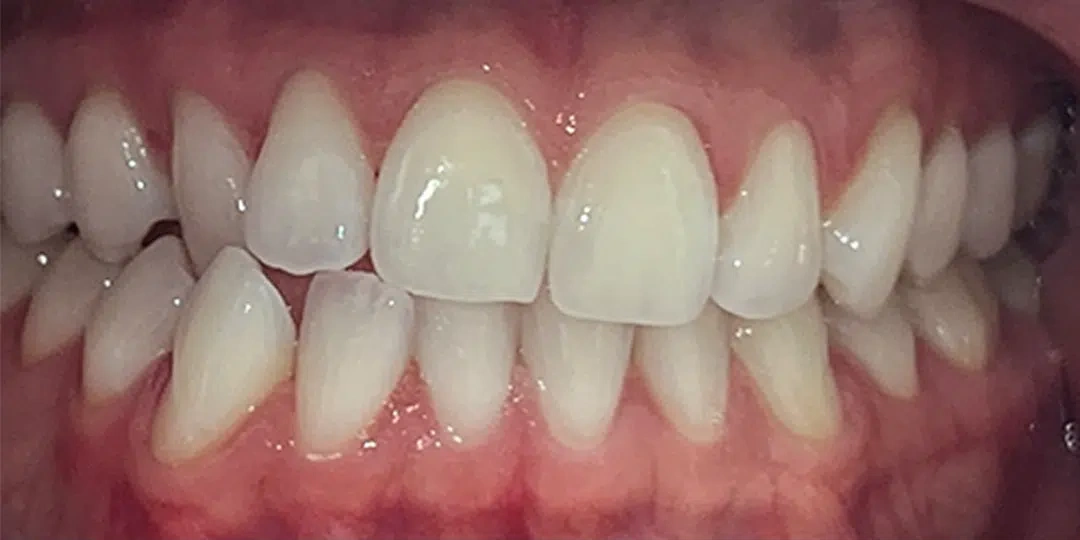 Before Invisalign treatment for crowded teeth