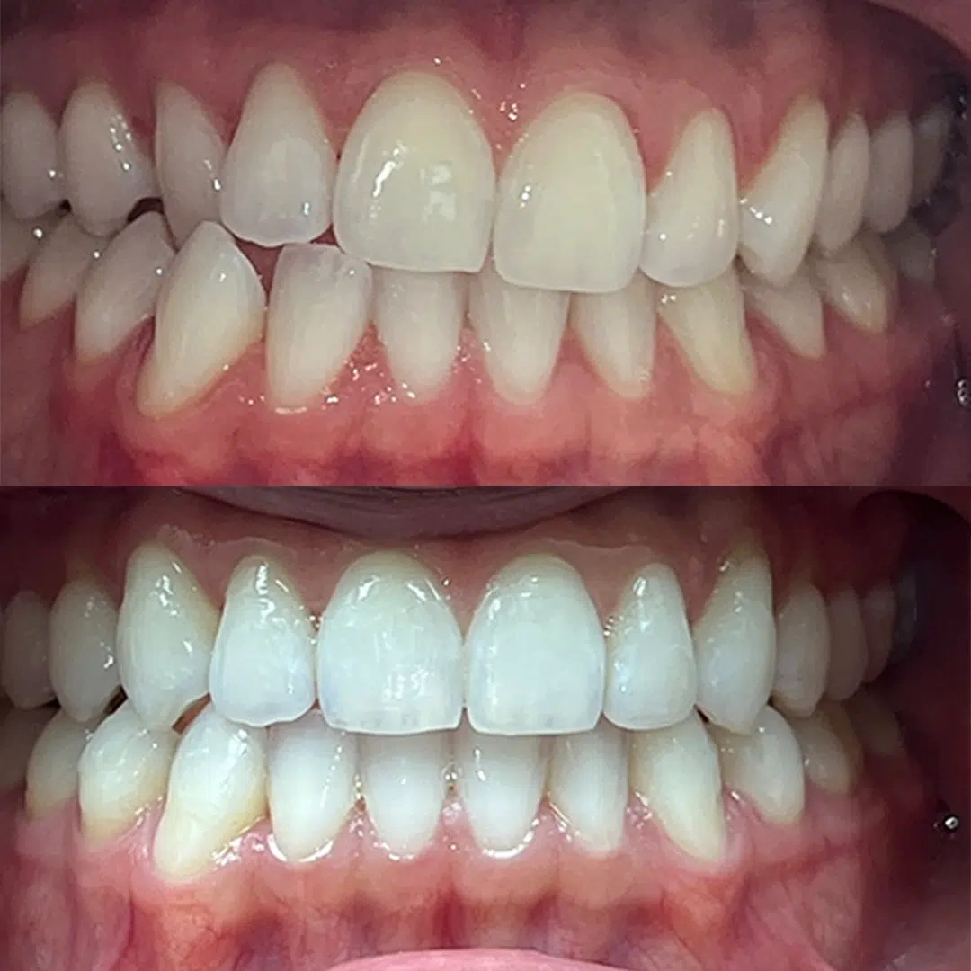 Invisalign Crowded Teeth Correction before/after