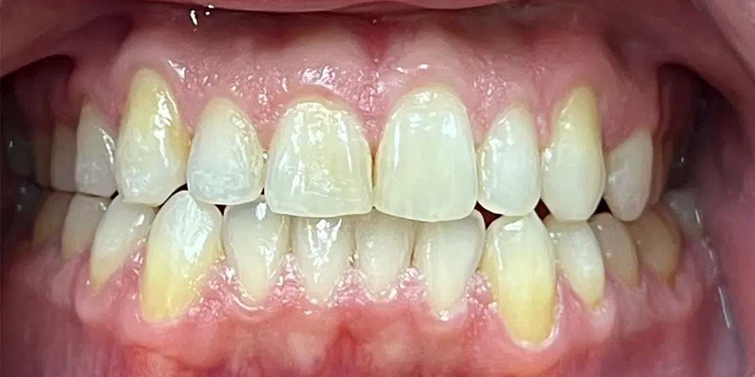 After Invisalign orthodontic treatment showing improved tooth alignment