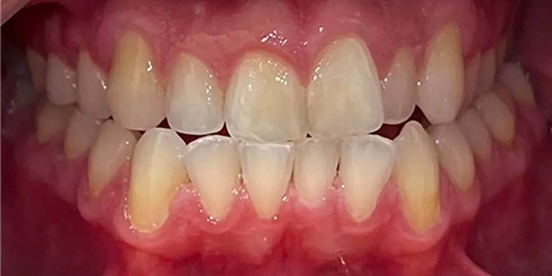 Before orthodontic treatment with Invisalign showing crooked teeth
