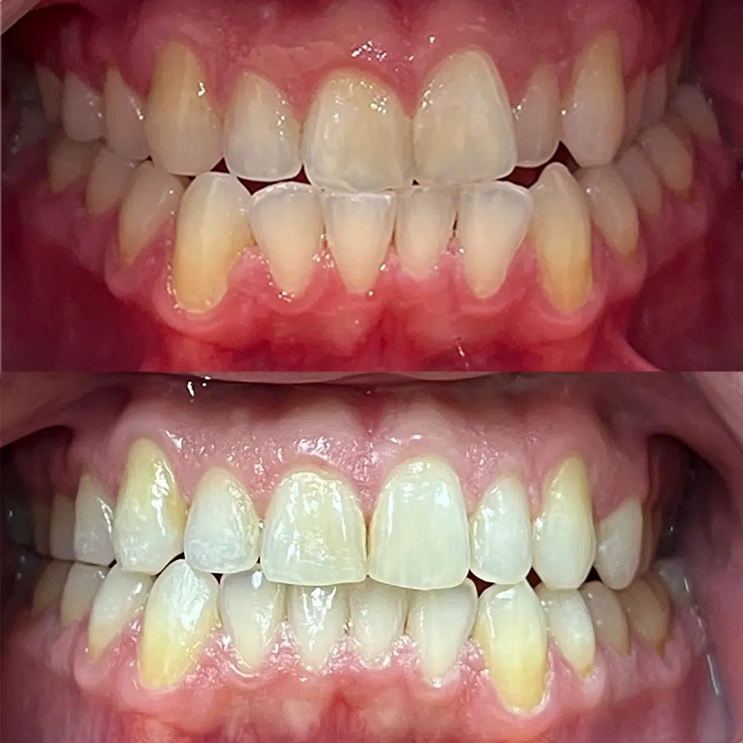 Invisalign Orthodontic Treatment before/after