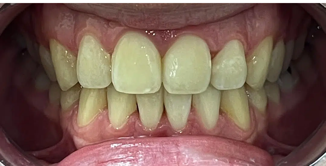 After Invisalign treatment showing a straighter, more aligned smile