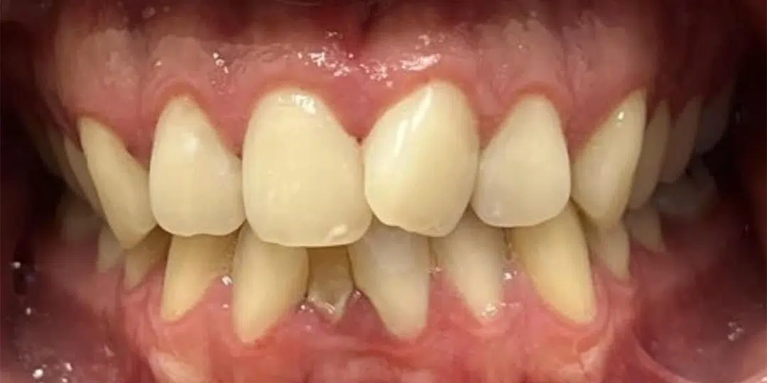 Before Invisalign treatment showing crowded and misaligned teeth