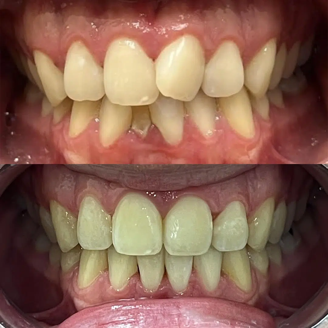 Invisalign Treatment before/after