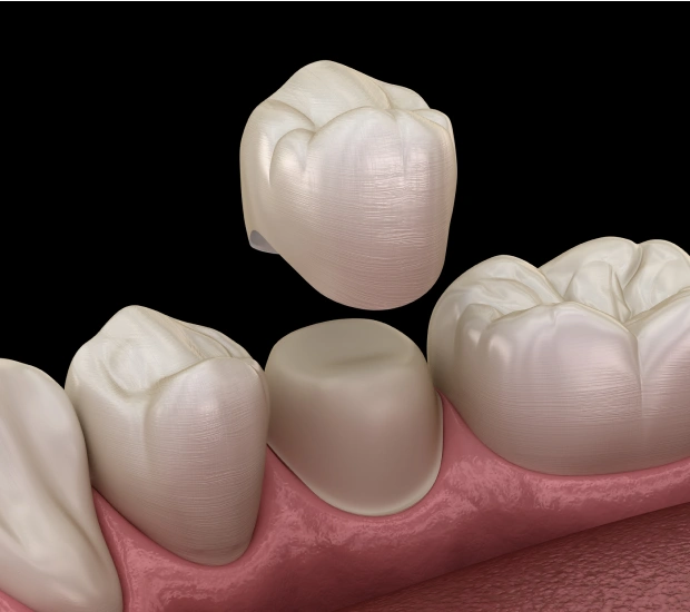 Porcelain dental crowns restoring strength and appearance