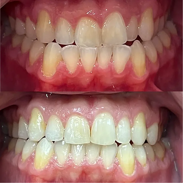 Before and after cosmetic dentistry smile transformation