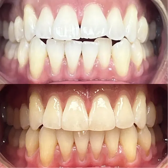 Before and after smile makeover results