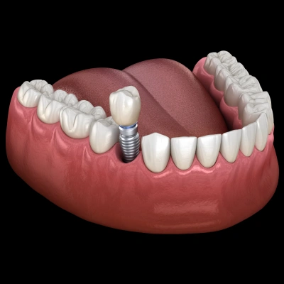 Single tooth dental implant replacing a missing tooth