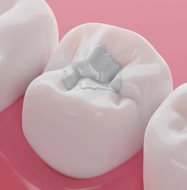 Restore Your Smile With Natural-looking Dental Fillings